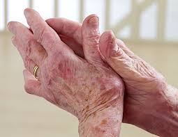 Many famous individuals, including actors, athletes, and politicians, have suffered from arthritis, but instead of letting such a condition break them, those listed below turned their struggle into a source of inspiration and encouragement for others. Arthritis History