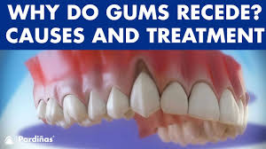 Gum Recession Treatment Of Gingival Retraction C Youtube