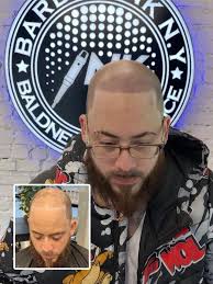 Expert Scalp Micropigmentation in NYC