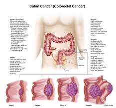 Symptoms could be caused by other conditions, but they could also be signs of cancer. Pin On Aaa