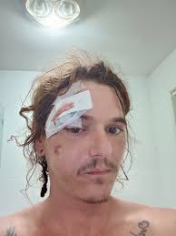 Severe Skateboarding Injury and Safety Discussion