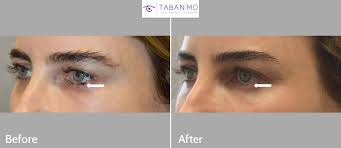 This eyelid problem looks like a skin tag and it can be multiple or solitary, rough or smooth and it is quite similar in color to adjacent skin. Eyelid Skin Cancer Before And After Photos Taban Md