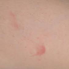 What are the signs & symptoms? Blutvergiftung Ist Das Moglich Madchen Leben Krank
