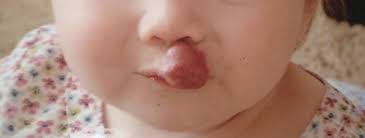 If you do have a que. New York Lip Hemangioma Treatment Before And After Photos