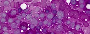 But in some cases, the cancer comes back (sometimes called relapse or recurrence depending on when it might occur after a transplant). What Is Bone Marrow Patient Education Ucsf Benioff Children S Hospitals