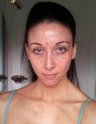 I came close to death using tan jab that killed bride-to be Jenna Vickers |