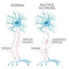 In ms, the immune system attacks the protective sheath (myelin) that covers nerve fibers and causes communication problems between your brain and the rest of your body. Multiple Sclerosis Symptoms And Causes Neurology Beaumont Health