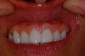 Signs of inner cheek cancer may include the following: Beginning Signs Of Mouth Cancer Utodent Com