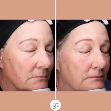Age Spots Removal in Carlsbad