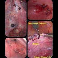 Unfortunately, gross's health scare didn't end there. 55 Endo Ideas Endometriosis Endometriosis Awareness Endometriosis Diet
