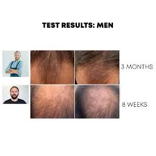 Obesity accelerates on hair loss forums, people often talk about changing their diet to a healthier one in order to see if it improves scalp hair. New Natucain Hair Loss Treatment 100ml