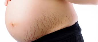 Stretch Marks Rash And Itchiness India Parenting