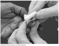 Image result for Capillary Puncture
