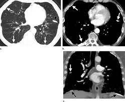 Diffuse thickening of the visceral pleura without interstitial involvement can. Asbestos Related Pleural Plaques Involving A Fissure And The Posterior Download Scientific Diagram