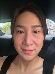 My face is sunken and looks a lot older than my age. Can it be improved  much now? Can any of the ladies in the group who have done it give me