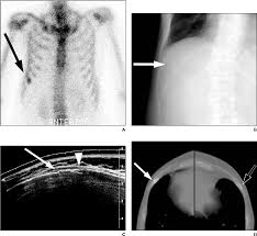 Rib or chest pain is a symptom of lung cancer. Figure 3 From High Resolution Sonography Of The Rib Can Fracture And Metastasis Be Differentiated Semantic Scholar