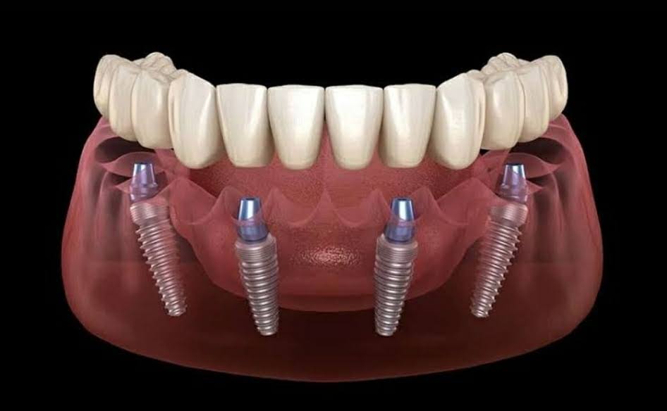 All 4 Dental Implant product image