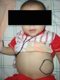 Children may seem very tired (lethargy), and parents may notice frequent bruises. Early Warning Signs And Diagnostic Approach In Childhood Cancer Springerlink