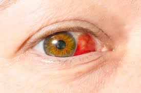 Bluterguss Im Auge Ursachen Und Gegenmassnahmen Heilpraxis