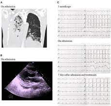 Case Report: Acute Myocarditis Due to PD-L1 Inhibitor Durvalumab  Monotherapy in a Patient With Lung Squamous Cell Carcinoma - Frontiers