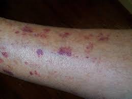 Lesions keep their dark colour often for several weeks and there is no abnormality in bleeding times. Bateman S Purpura And How It Causes Bruising In The Elderly