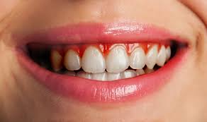 It's typically caused by poor brushing and flossing habits that allow plaque—a sticky film of bacteria—to build up. Gum Disease Treatment Oxford Dentist