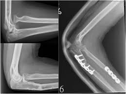Image result for Radial Head Dislocation