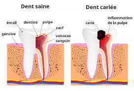 Si vous avez une toute petite carie, le dentiste peut juger que vous n'avez pas besoin d'une anesthésie pour subir le traitement. Soigner Une Carie Dentaire