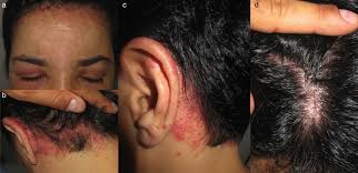 Image result for dermatitis contacta allergica