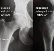 Reemplazo total de cadera (Total Hip Replacement ...
