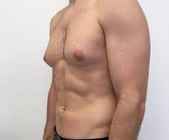 Differential diagnosis for male breast cancer. Male Breast Reduction How Can I Get Rid Of Gynecomastia Fast