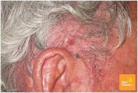 If your diagnosis is thyroid cancer, you may be able to breathe a bit easier, as it's one of the most treatable cancers when caugh. Skin Cancer On Scalp Skin Check Waskin Check Wa