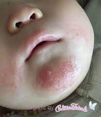 Eczema Is Different For Infants Toddlers First 6 Months Eczema Usually Appears On The Face Cheeks Chin Forehead Scal Skin Bumps Rash On Face Baby Cheeks