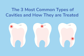 Small surface cavities can be filled in less than 30 minutes with little to no discomfort. The 3 Types Of Cavities How To Treat And Prevent Them Gentle Dental