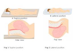 Back Sleeping And Stillbirth Revisited A Reason For Caution Or A Few Extra Pillows Expecting Science