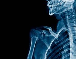 Like somebody has kicked me in the back. Risk Vs Benefit Bisphosphonates In Breast Cancer