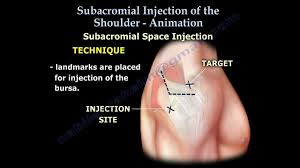 Image result for Subacromial Space Injection