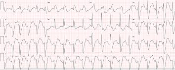 Image result for Loperamide Abuse