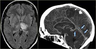 Little is known concerning the corresponding diagnostic value of. The Radiology Assistant Cerebral Venous Thrombosis