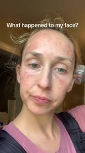 How to Remove Sun Casting