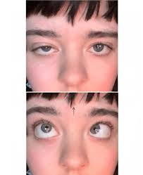 undiagnosed) is it dumb to be ignoring my ptosis? : r/MyastheniaGravis