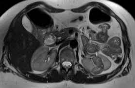 Diagnostik Des Nierenzellkarzinoms Nierenzellkarzinom Erkrankungen Therapien Urologie Uniklinik Koln