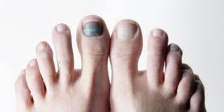Suelen aparecer debido a elementos del entorno externo, como por ejemplo el color puede variar a verde, marrón, gris o incluso negro. Una Del Pie Negra Que Es Causas Y Tratamiento