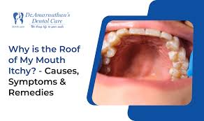 Image result for oral thrush symptoms roof of the mouth