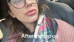 Faye Lips Before and After