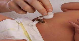 Cara cek tagihan pbb online. Tali Pusat Bayi Baru Lahir Tak Di Jaga Dengan Betul Boleh Sebabkan Jangkitan Kuman Demam Panas Pa Ma