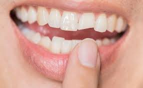 Can it be filled or can his tooth be made even? Cracked Tooth Repair And 5 Reasons To Visit A Cosmetic Dentist