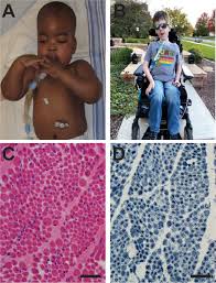 Image result for Myopathy
