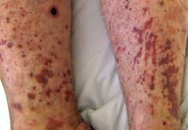 Kaposi sarcoma is a disease in which cancer cells may, among other things, cause purple skin lesions. Cutaneous Vasculitis More Than Skin Deep Consult Qd