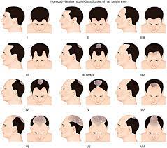 Hair growth occurs in a cycle. Male Pattern Baldness Tir Na Nog Clinic Hair Restoration Medical And Surgical Aesthetics
